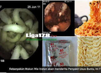 Kebanyakan Makan Mie Instan akan menderita Penyakit Usus Buntu, Ini Faktanya Mi Instan, Facebook, cacing Ascaris, WHO, Liga178 News