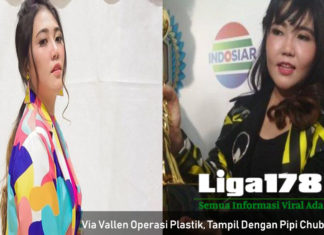 Via Vallen Operasi Plastik, Tampil Dengan Pipi Chubby Nya